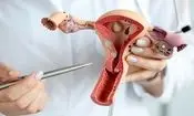 تشخیص دیرهنگام آندومتریوز؛ تهدیدی برای باروری زنان