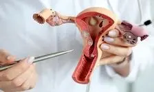 تشخیص دیرهنگام آندومتریوز؛ تهدیدی برای باروری زنان