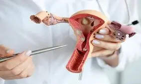 تشخیص دیرهنگام آندومتریوز؛ تهدیدی برای باروری زنان