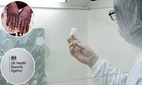 آبله میمونی شباهتی به آبله مرغان ندارد/ چگونه ایمن شویم؟