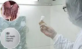 آبله میمونی شباهتی به آبله مرغان ندارد/ چگونه ایمن شویم؟