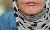 مرد بی‌رحم لب‌های زن ۱۸ ساله‌اش را دوخت/ فائزه به کلانتری پناه برد