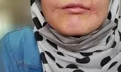 مرد بی‌رحم لب‌های زن ۱۸ ساله‌اش را دوخت/ فائزه به کلانتری پناه برد