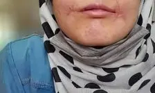 مرد بی‌رحم لب‌های زن ۱۸ ساله‌اش را دوخت/ فائزه به کلانتری پناه برد