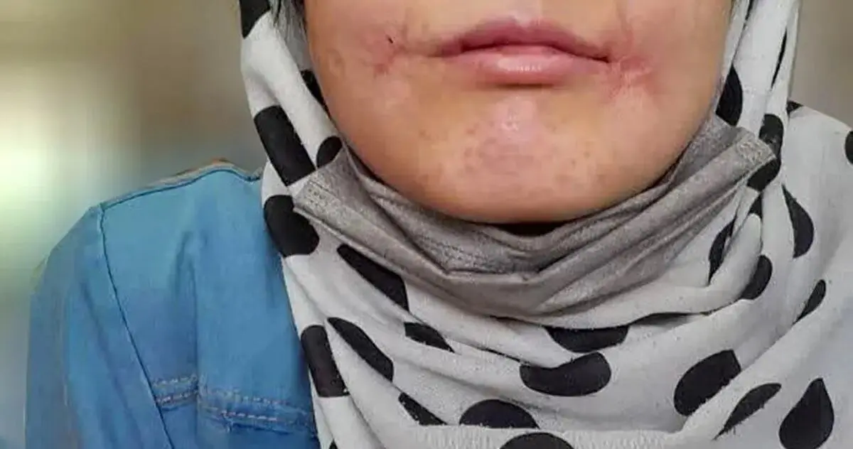 مرد بی‌رحم لب‌های زن ۱۸ ساله‌اش را دوخت/ فائزه به کلانتری پناه برد