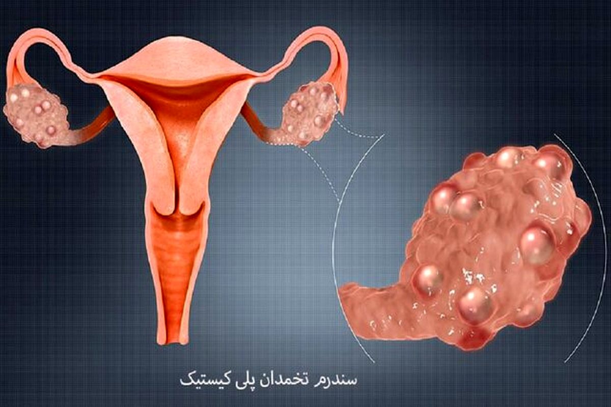 گیاهان دارویی موثر در درمان سندرم تخمدان پلی کیستیک