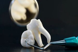 دندان عقل نهفته چیست؟