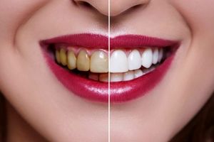 با ارزان ترین و گران ترین روش های سفید کردن دندان آشنا شوید