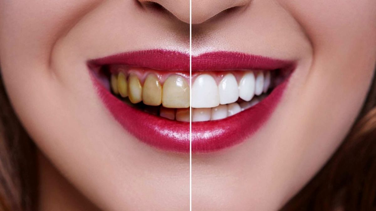 با ارزان ترین و گران ترین روش های سفید کردن دندان آشنا شوید