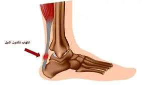 تاندونیت آشیل چیست؟