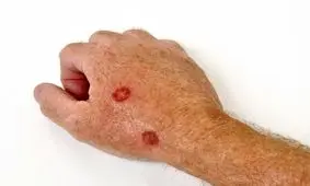 سرطان پوست را با نیش حشرات اشتباه نگیرید