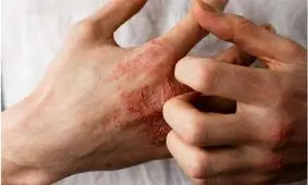 درمان های خانگی برای رفع خشکی پوست