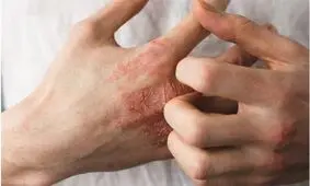 درمان های خانگی برای رفع خشکی پوست