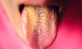 چطور می‌توان زردی زبان را درمان کرد؟