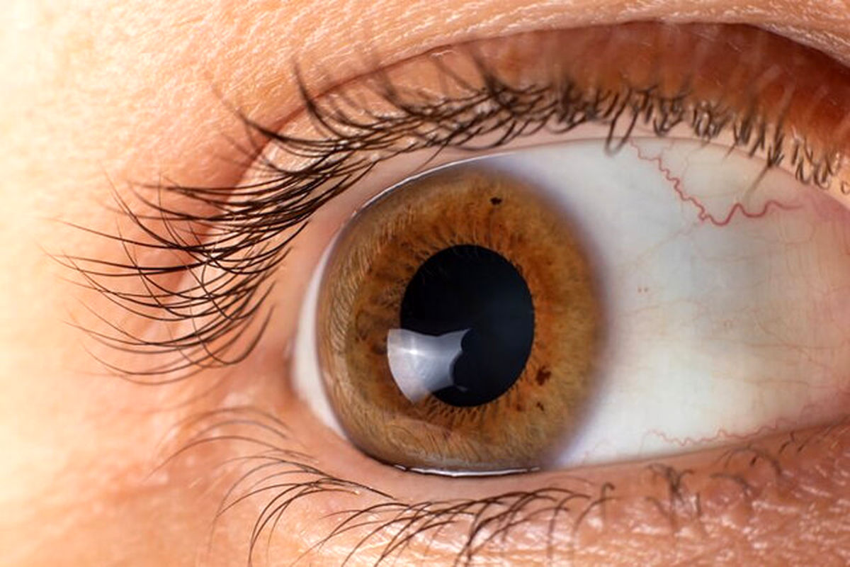 آستیگمات چشمی با لیزیک درمان می‌شود؟/ ویدئو