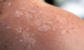 هشدارها و توصیه هایی برای پیشگیری از سرطان پوست/ ویدئو