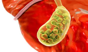 علائم شایع سنگ کیسه صفرا