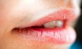 چطور از خشکی لب در زمستان رها شویم؟