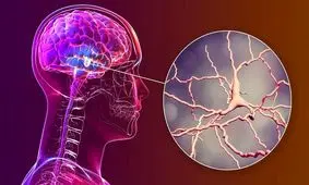 نتایج امیدوارکننده یک ساختار نانویی برای مقابله با پارکینسون

