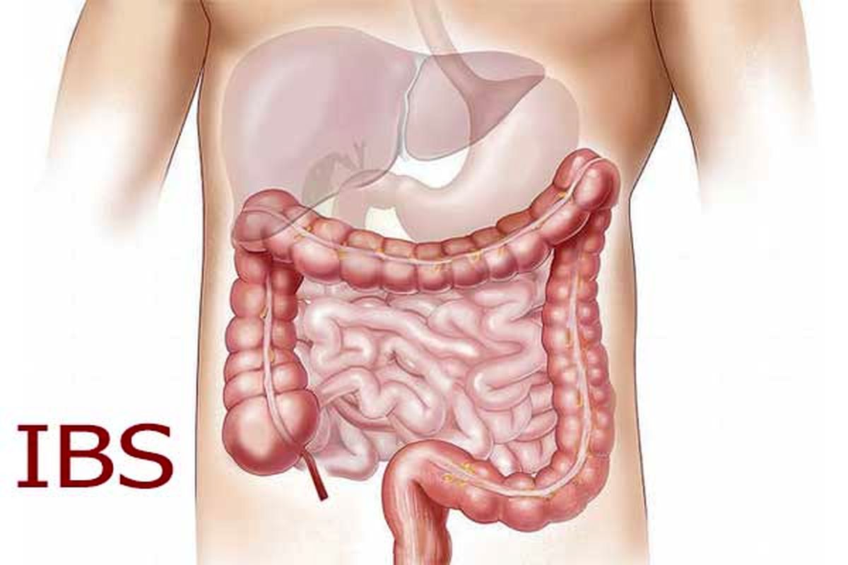 9 توصیه پزشکی برای درمان طبیعی سندروم روده تحریک پذیر