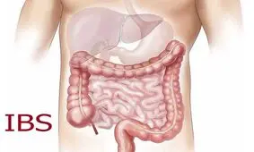 9 توصیه پزشکی برای درمان طبیعی سندروم روده تحریک پذیر
