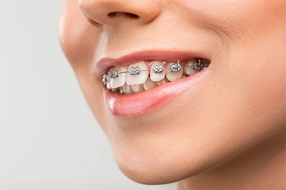 ارتودنسی چیست و چه مراحلی دارد؟ (همراه با عکس مراحل ارتودنسی)