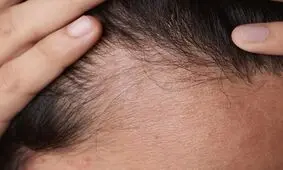 دلایل ریزش مو چیست؟