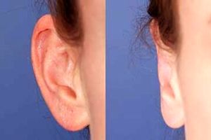 گوش بَلبَلی قابل درمان است؟