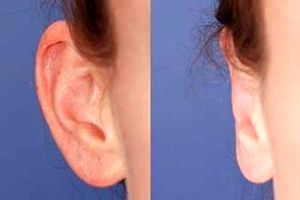 گوش بَلبَلی قابل درمان است؟