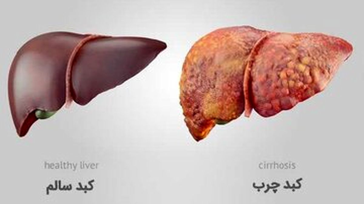  چگونه به کبد چرب مبتلا نشویم؟ 