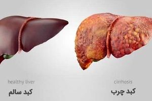 چگونه به کبد چرب مبتلا نشویم؟