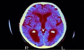 فراموشی زودهنگام در کودکان؛ یک دلیل خطرناک