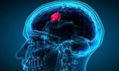 روش جدید برای تخمین طول عمر افراد دارای تومور مغزی