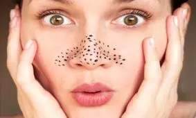 از بین بردن جوش سر سیاه با 8 روش خانگی