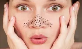 از بین بردن جوش سر سیاه با 8 روش خانگی