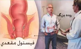 همه چیز درباره درمان فیستول با لیزر