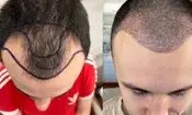 قیمت کاشت مو در تهران؛ بررسی هزینه‌ها و عوامل مؤثر بر آن