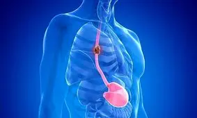 چه چیزی باعث سرطان مری می‌شود؟