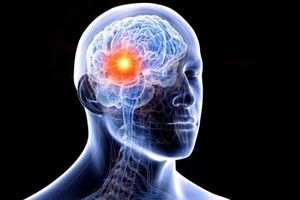 شایع ترین علت خونریزی مغزی را بشناسیم