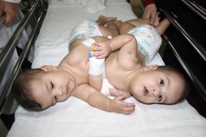 جداسازی خواهران دوقلو در بیمارستان نمازی شیراز