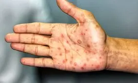 چرا سیفلیس در سرتاسر جهان در حال افزایش است؟