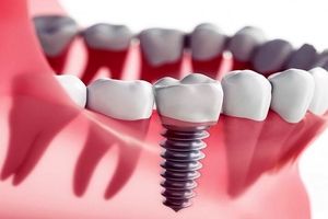 ایمپلنت دندان یا دندان مصنوعی؟ کدام بهتر است؟