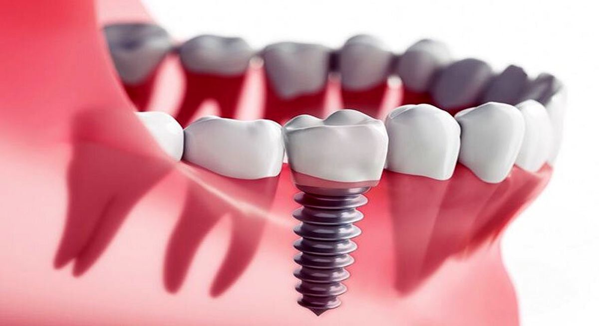 ایمپلنت دندان یا دندان مصنوعی؟ کدام بهتر است؟
