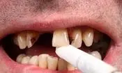 دندان سیگاری ها ۴ برابر افراد دیگر خراب می‌شود