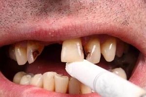 دندان سیگاری ها ۴ برابر افراد دیگر خراب می‌شود