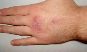 مواد شوینده لباسشویی سد محافظتی پوست را تضعیف می‌کند