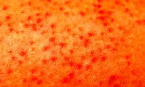 جوش بعد از لیزر موهای زائد چه دلیلی دارد؟