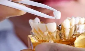 همه چیز درباره پروتز دندان