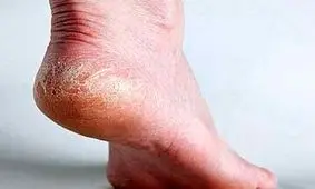 علت ایجاد «خار پاشنه» چیست و چگونه درمان می‌شود؟