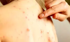 زنگ خطر شیوع مجدد سرخک به صدا درآمد